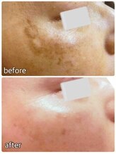 ブランシェ 富山店 × 椿/シミケア　お客様