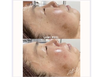 リラクゼーションアンドビューティーボヌール(BONHENR)/ラミネーションピールの効果