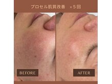 フォーケア(4Care)の雰囲気（プロセル BeforeAfter毛穴小・シミしわ軽減・エステ版ダーマ）