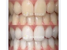 セルフダック 宮城角田店(SELFDUCK)/セルフホワイトニング症例写真