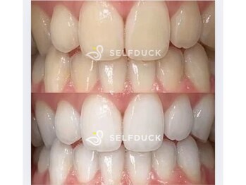 セルフダック 宮城角田店(SELFDUCK)/セルフホワイトニング症例写真