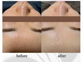 アン ビューティー(ann beauty)/施術1回【症例写真】