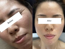 ジョーヌ(JAUNE)/毛穴悩みも根本改善！