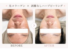 パールプラス 大垣店(Pearl plus)/複数回での施術でお肌悩みが改善