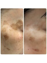 アヤズ サロン(AYA's SALON)/シミが気になる方に