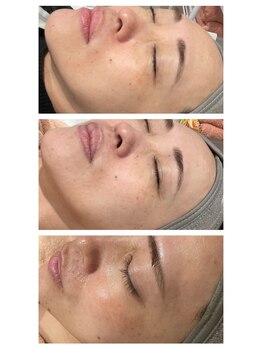 アリウム(Allium)/ハーブピーリング