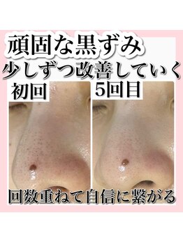 ホワイトアクア 新宿本店(WHITE AQUA)/ハーブピーリング/東京/新宿