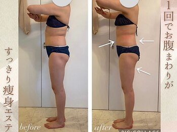 ラナ(LaNa)/気になるセルライト撃退