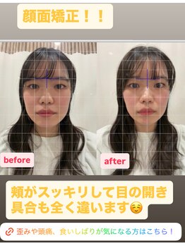 ホネツギ 柏駅西口接骨院(HONETSUGI)/【顔面矯正】before/after