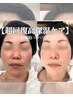 【超即効性◎】ヒト幹細胞×はり美容で超回復高保湿ケア　¥12300
