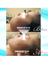 PMK 千葉店/パワー筋膜ツリー1回