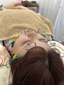 フォーユー 大和郡山院(for you)/肩甲骨はがし付き美容鍼