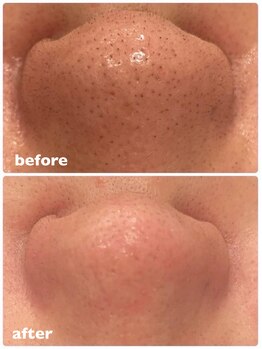 リリーラボ(LILY LAB)/毛穴の奥まで、徹底リセット♪