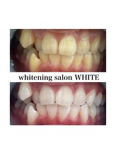 ホワイトニングサロン ホワイト 津山店(WHITE)/ビフォーアフター