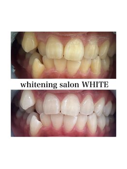 ホワイトニングサロン ホワイト 津山店(WHITE)/ビフォーアフター