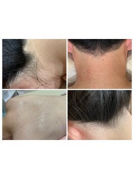 脱毛デビューにオススメのサロン