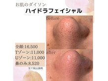 お肌のダイソン「ハイドラフェイシャル」で毛穴ケア♪