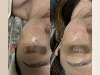 ルンルン(run run)/1回のケアでドーアップ