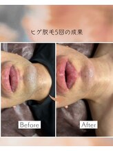 オフ(off)/ヒゲ脱毛