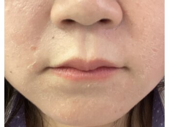 エクラ/レチノールのA反応