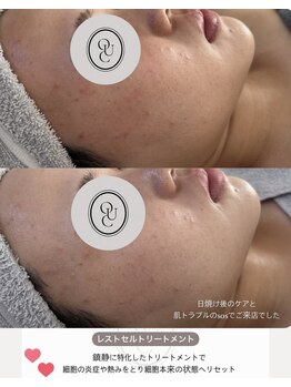 凰湖/肌質改善