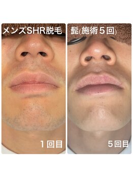 ネイキッドベージュ 麻布十番店(Naked Beige)/メンズSHR★ビフォーアフター