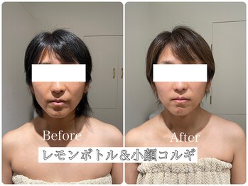 イデアルミー 大宮店(イデアルMe)/レモンボトル＆小顔コルギ