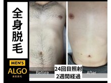 アルゴ 山口店(ALGO)/メンズ脱毛