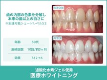 クレア(Crea)/【歯のホワイトニング症例写真】