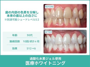 クレア(Crea)/【歯のホワイトニング症例写真】