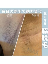 脱毛マックス 南越谷店(MAX)/【男女人気脇】Before★After
