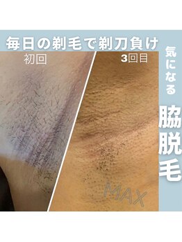脱毛マックス 南越谷店(MAX)/【男女人気脇】Before★After