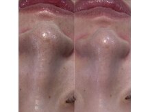 バイカラー(BY COLOR)/ハイドラ毛穴洗浄