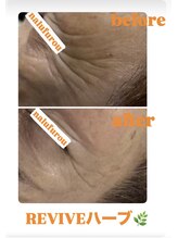 ナルフロウ(nalufurou)/剥離なし国産ハーブピーリング☆