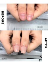 リミズネイルビューティー 名駅店(RimisNailxbeauty)/深爪・噛み爪改善
