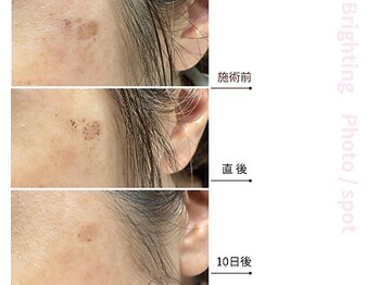 ドアディ(Doordie)/Brightingフォト　しみケア 