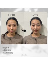 リベルタ鍼灸整骨院 なんば店(Liberta鍼灸整骨院)/眼精疲労も改善できますか？