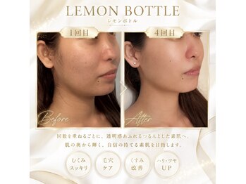 ブリリアントスマイル/たるみにはレモンボトル