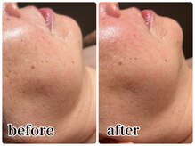 ジェミニ フェイス デザイン(Gemini Face Design)/REVIハーブピーリング