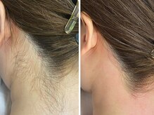 ルラ 池袋東口店(LULA)/うなじ脱毛