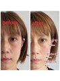 雅 クリニカルルーム 小顔調整(フェイスケア)も人気です。施術後に驚いて下さい♪♪