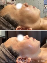 リアン 南熊本店(Lien)/ブラックハーブ　毛穴改善・痩身