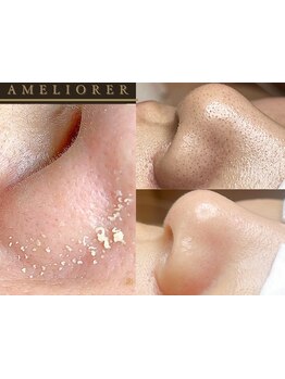 毛穴ケアをしたい