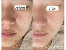 肌荒れを根本改善！ノーファンデ肌を目指します♪