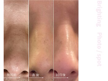 ドアディ(Doordie)/Brightingフォト　しみケア 