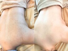 サロン ガトレオ(GatoLeo)の雰囲気（ブライダルの背中ニキビ・毛孔性苔癬。痛みに弱い初めての方も。）