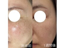 デミーナボーテ(DemynaBeaute)の雰囲気（最新！話題沸騰のシミケア◎別人レベルで変化しちゃう☆）
