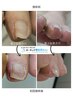 【巻き爪矯正】70度(1か所あたり)¥7,700