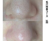 ボニータ(Bonita)/毛穴エクストラクション