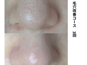 ボニータ(Bonita)/毛穴エクストラクション